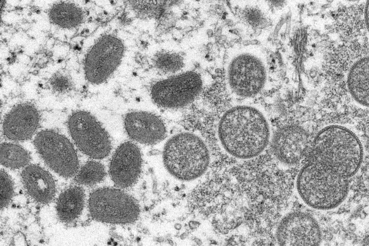 Brasil tem 592 casos confirmados de varíola dos macacos; veja lista de sintomas e como se proteger